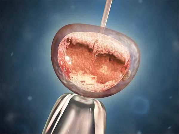 国内供卵一颗卵多少钱,试管婴儿一代二代三代费用,试管一代二代三代费用区别